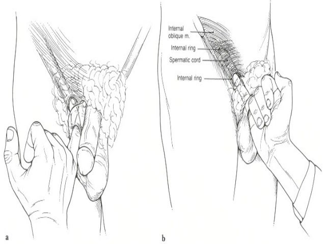 test hernia